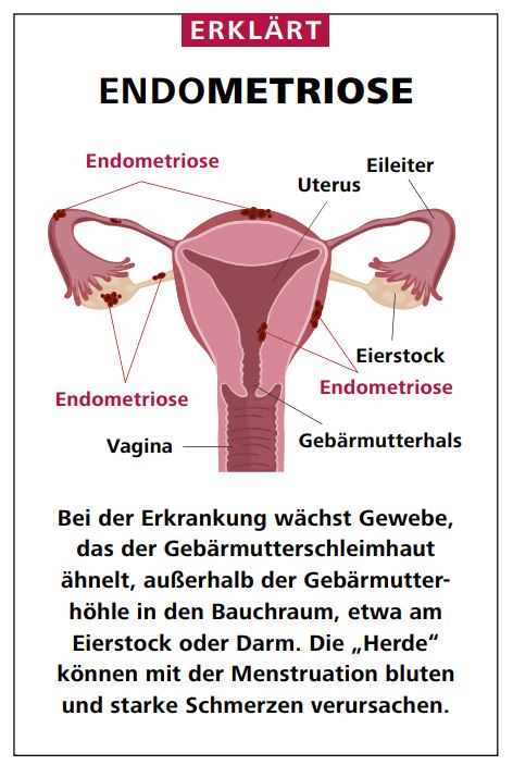endometriose-schaubild-vivantes