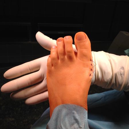 Hand eines Fußchirurgen zeigt Naht am Fuß eines Patienten