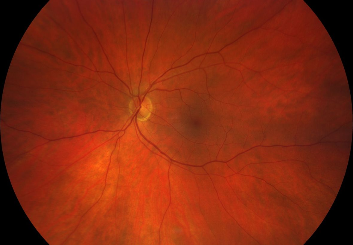 mithilfe eines Mikroskops wurde eine Aufnahme vom Auge gemacht, wie es von hinten betrachtet aussieht: roter Kreis mit Adern und einem hellen Fleck