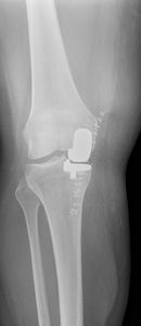 Röntgenbild einer Teilprothese im Knie