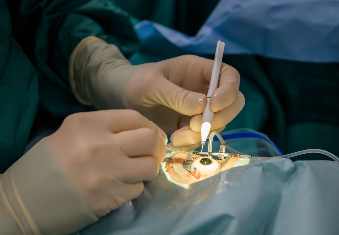 Chirurgische Hände in OP-Handschuhen operieren am offenen Auge, das durch Licht erleuchtet ist und weit aufgerissen ist