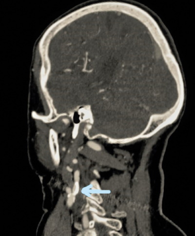 MRT-Bild zeigt Verengung am Halsgefäß